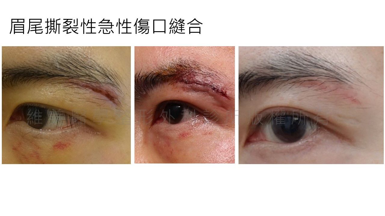 眉尾撕裂性急性伤口缝合