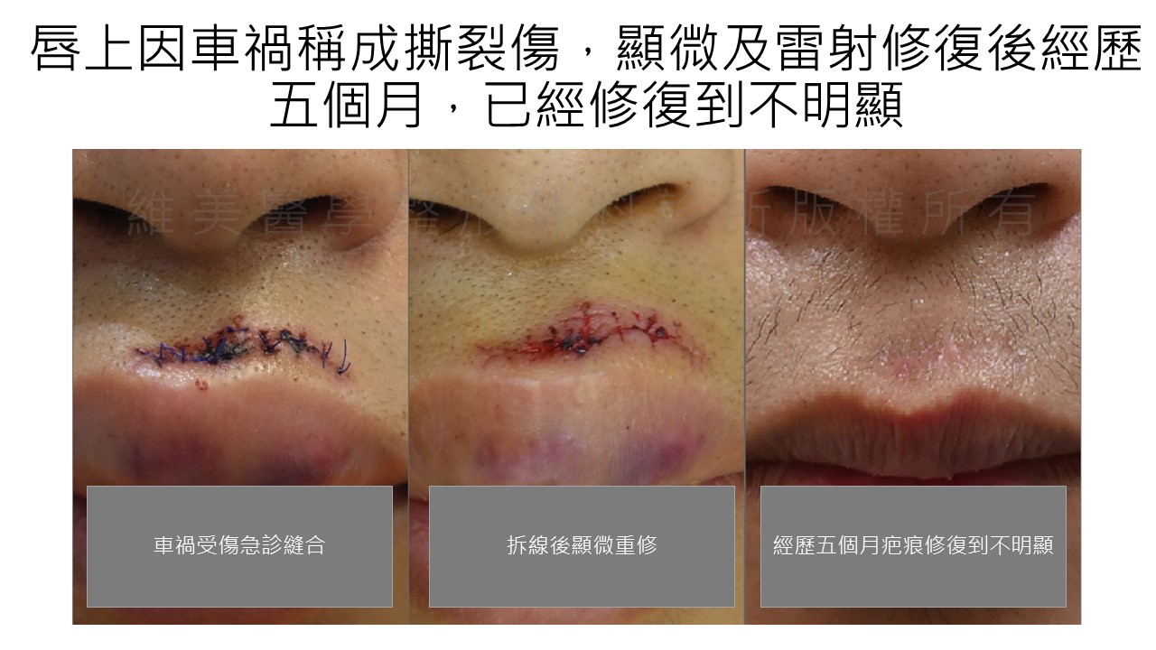 将伤口肌肉组织层一层一层缝合,外层再用最细美容针线缝合伤口,拆线后