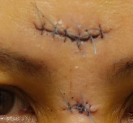 外院縫合狀態不佳,極可能導致疤痕增生