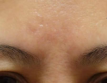 疤痕經過真皮移植修復