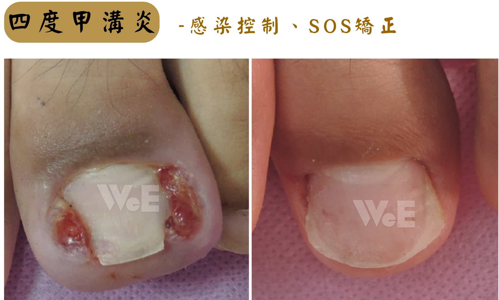 「甲溝炎治療前後對比-黃維超醫師SOS甲床重建術」