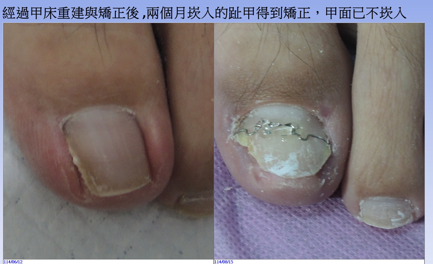 甲溝炎治療前後對比-黃維超醫師SOS甲床重建術(2)