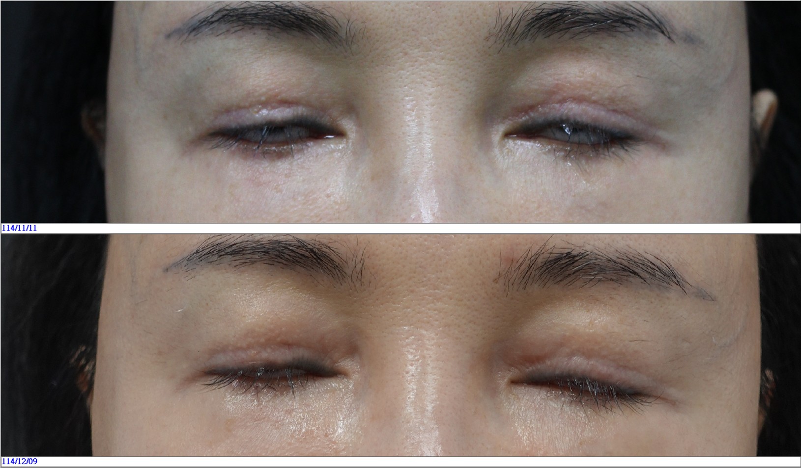 閉眼不全可以利用BIONE來進行改善