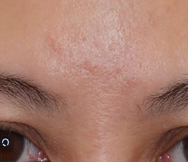 疤痕完美修復成果展示