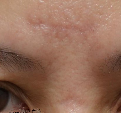 術後三個月配合UP雷射修復