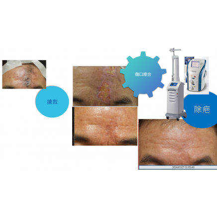 疤痕修復成果