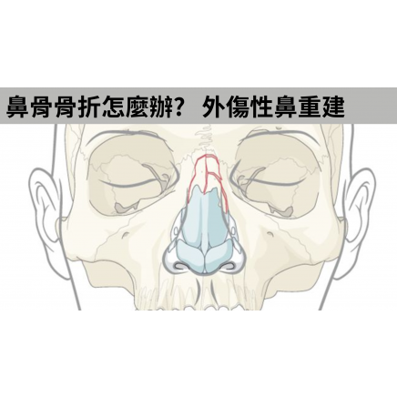 外傷性鼻骨骨折 臉部骨折 文章資訊 維美醫學整形外科診所