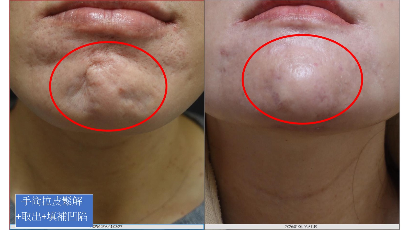 下巴輪廓修復術前術後對比圖