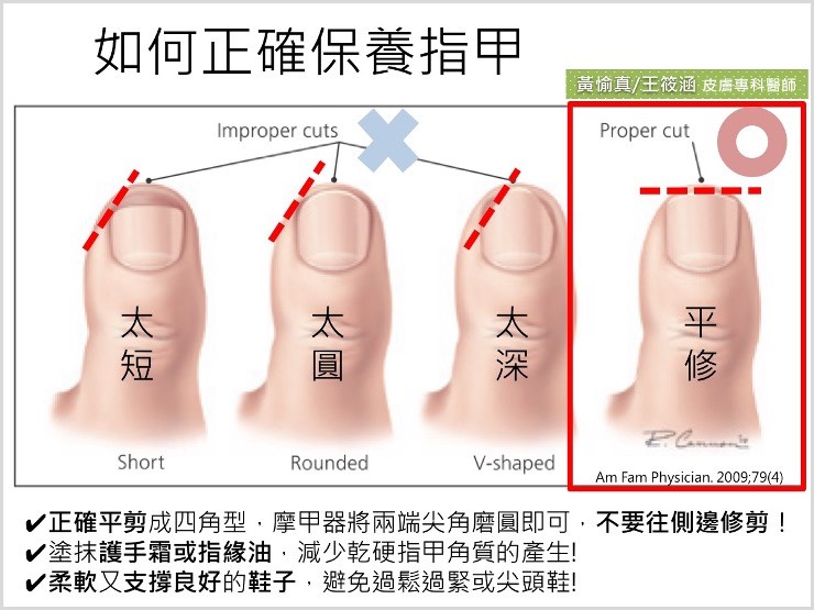 如何正確修剪指甲