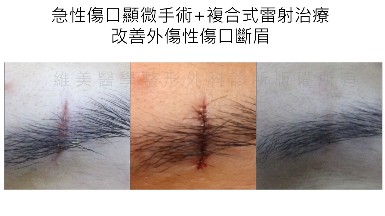 急性傷口顯微手術，加上複合式雷射治療，有效改善外傷性傷口斷眉。