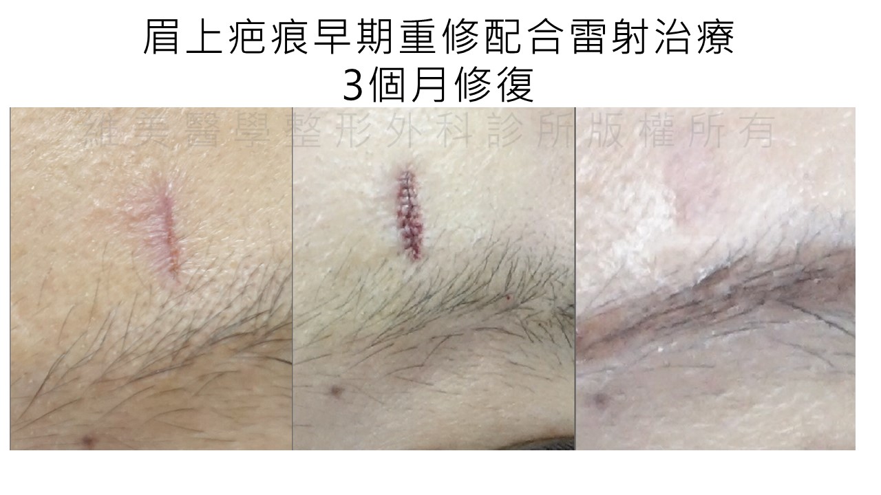 眉上疤痕早期重修,配合雷射治療,3個月修復。