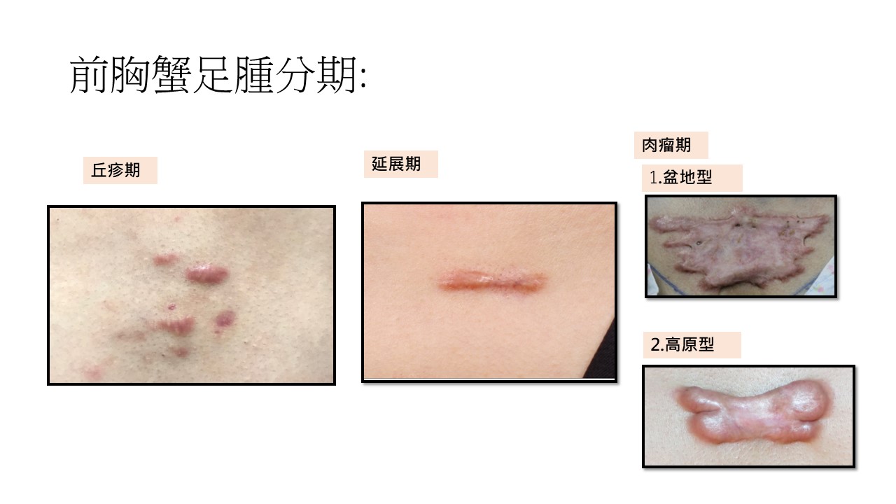 蟹足腫