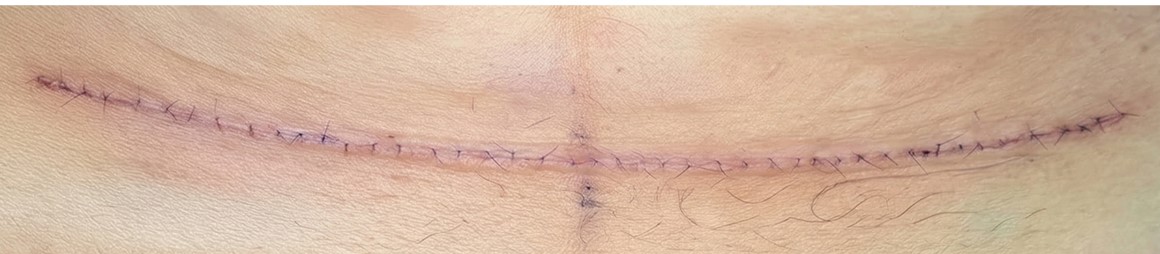 剖腹產疤痕減張縫合實例圖a