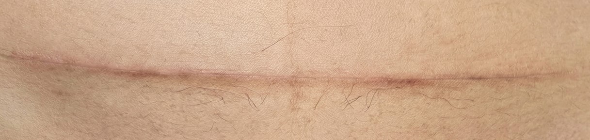 剖腹產疤痕減張縫合實例圖b