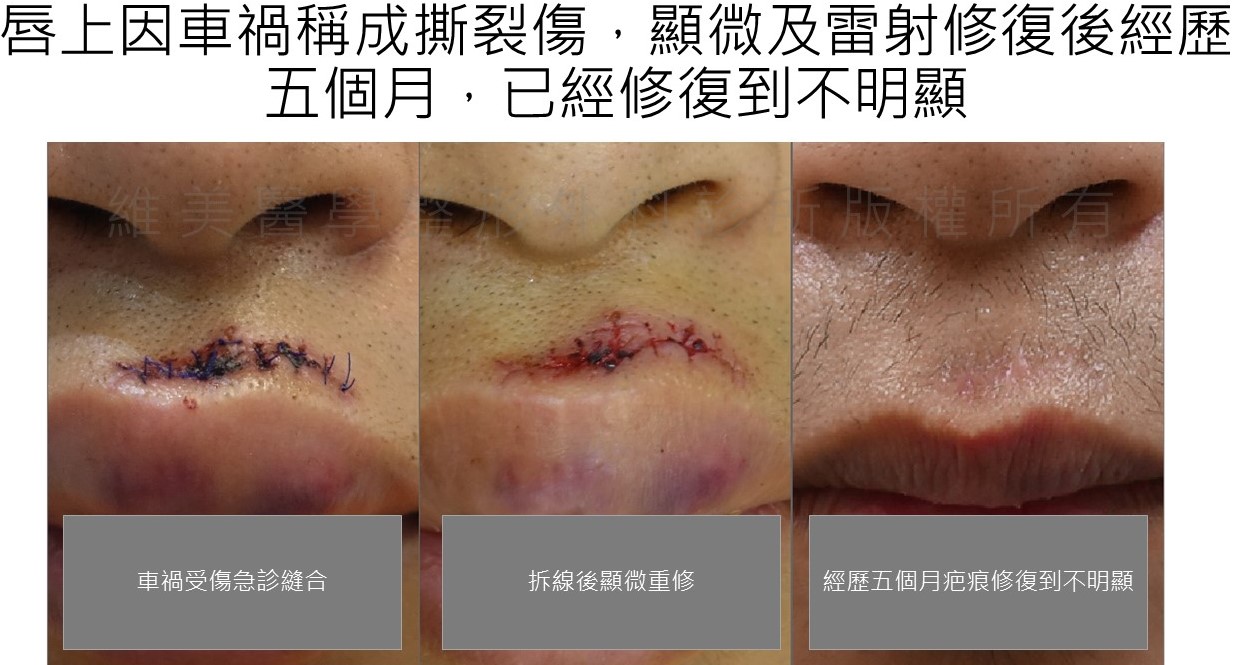 唇上因車禍造成撕裂傷，顯微及雷射修復後，經歷五個月，疤痕已經修復到不明顯。
