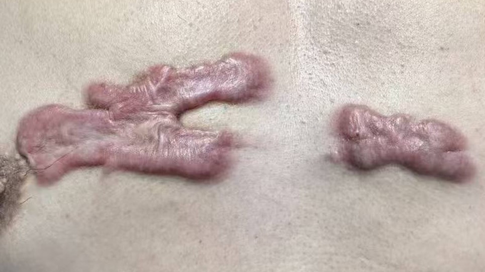 蟹足腫環鑽法治療前病灶照片