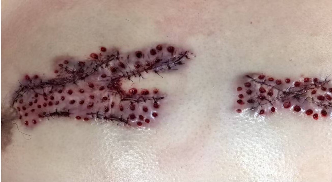 蟹足腫環鑽法棋盤式穿刺後傷口照片