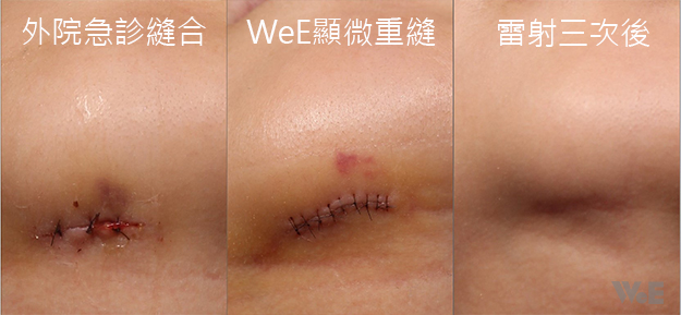下巴撕裂傷經過WeE顯微重逢,已幾乎看不見疤痕
