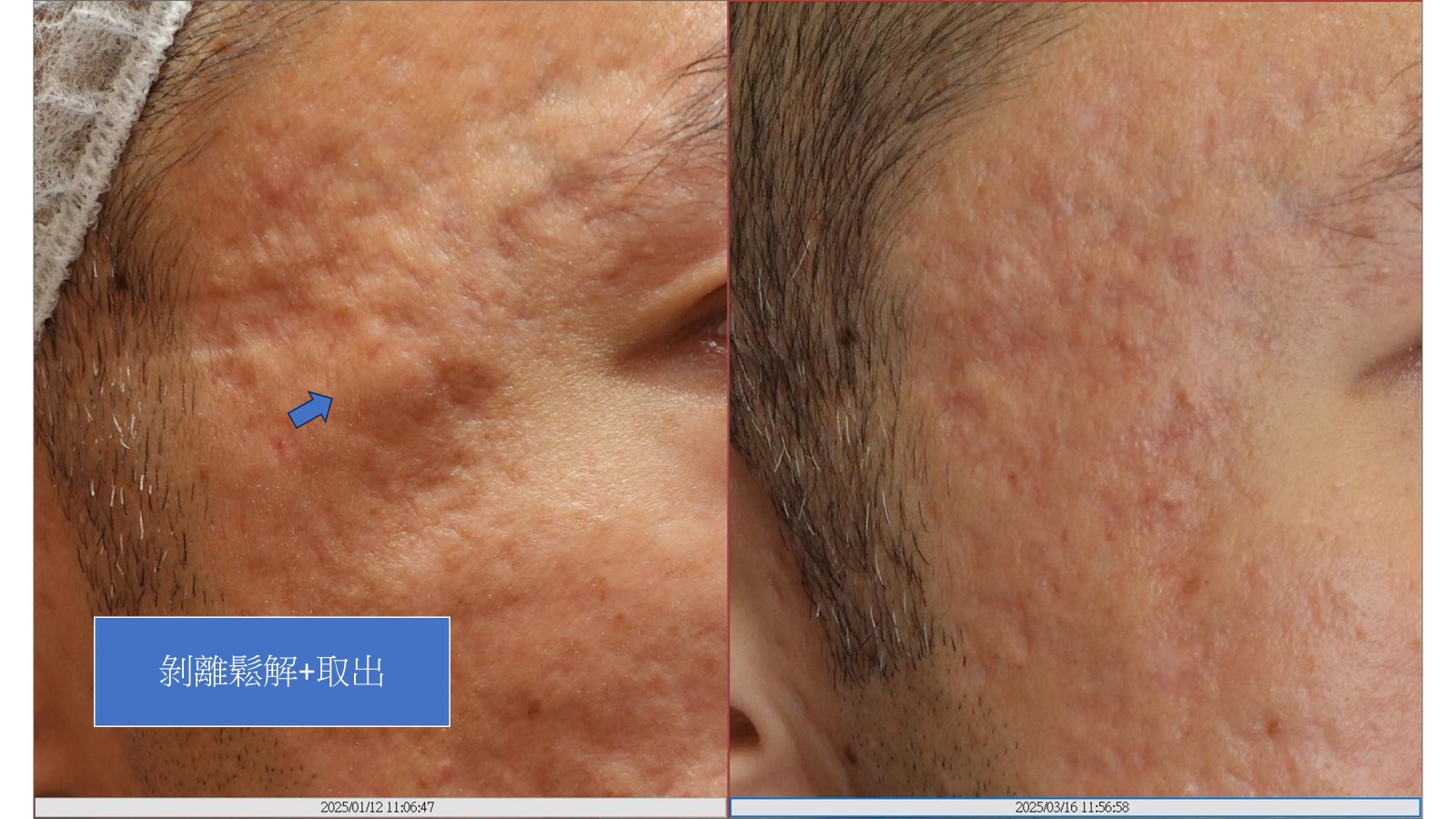 痤瘡疤痕採用剝離鬆解技術處理，術後皮膚的平整度得到顯著改善