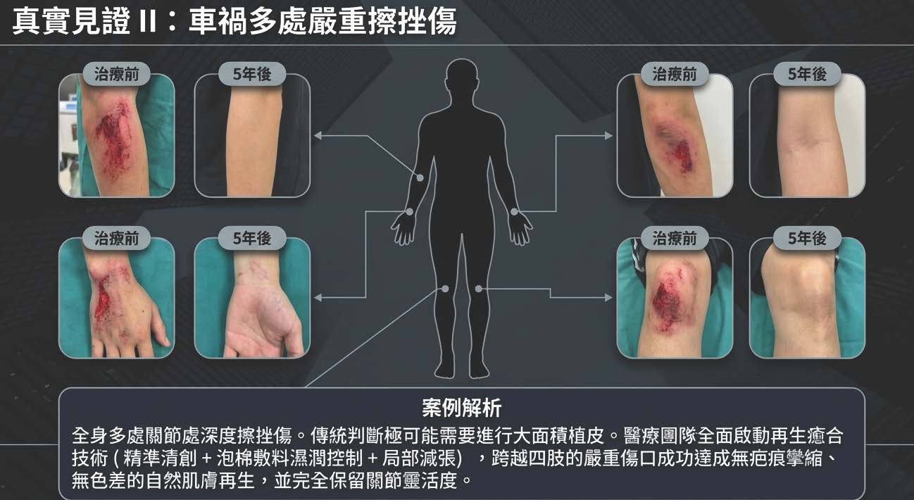 車禍多處嚴重擦挫傷免植皮修復案例