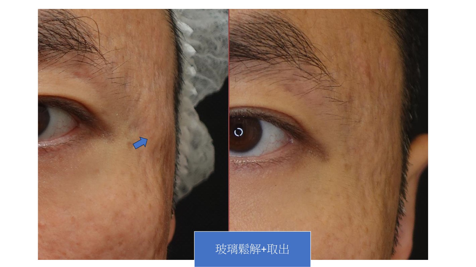 玻璃質酸酶溶解+取出，術後突起完全消失，恢復了眼周的平滑外觀
