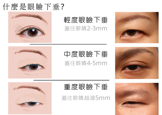 什麼是眼瞼下垂_下垂程度解析