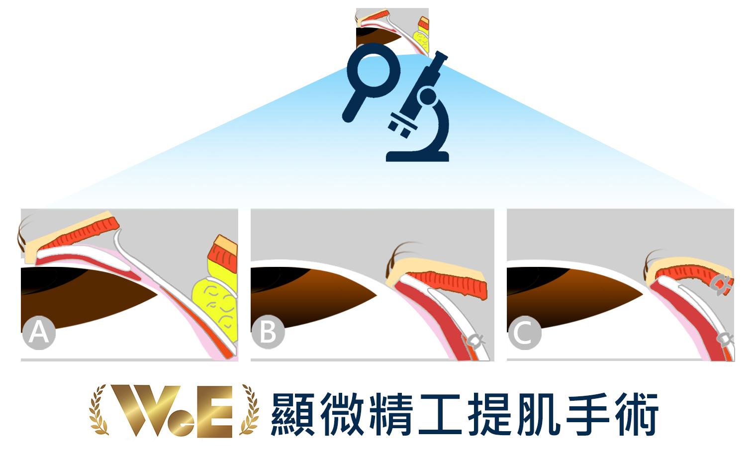 雙眼皮顯微手術_示意圖