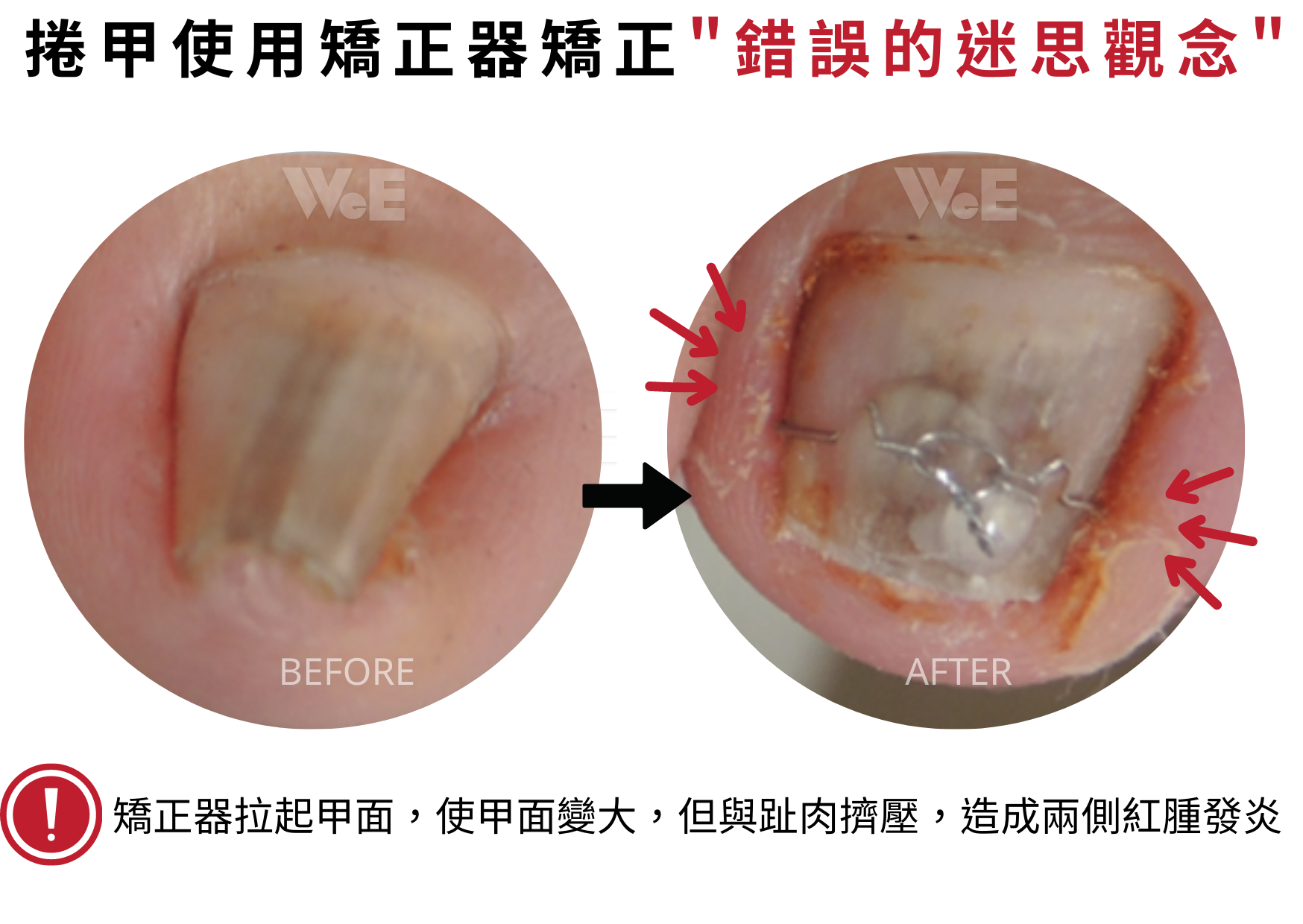 凍甲矯正_錯誤迷思治療案例