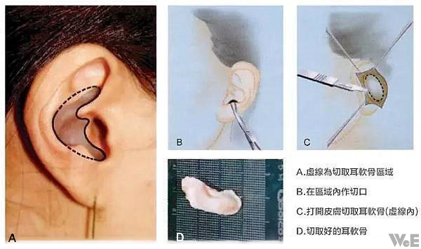 耳軟骨的應用