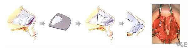鼻中隔軟骨的應用
