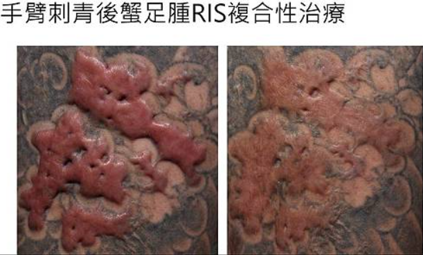 蟹足腫
