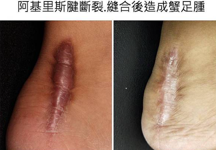 蟹足腫