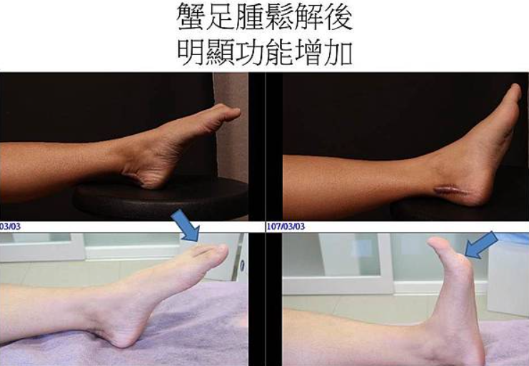 蟹足腫