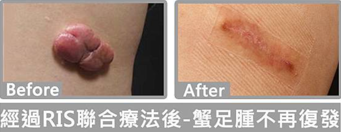 蟹足腫
