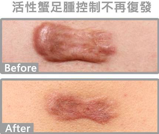 蟹足腫