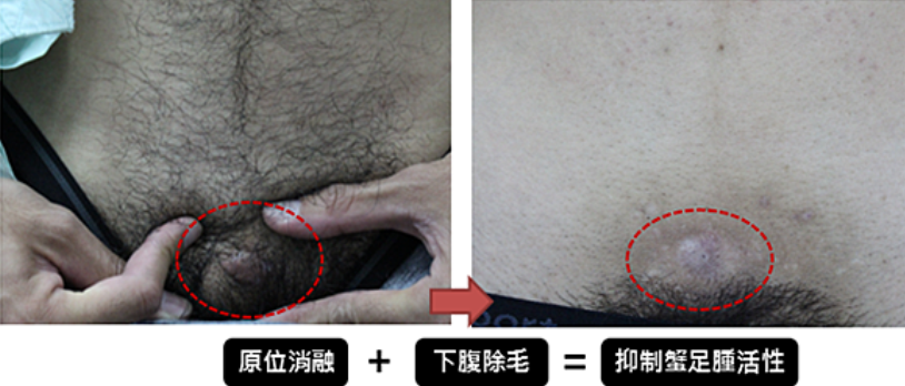 蟹足腫