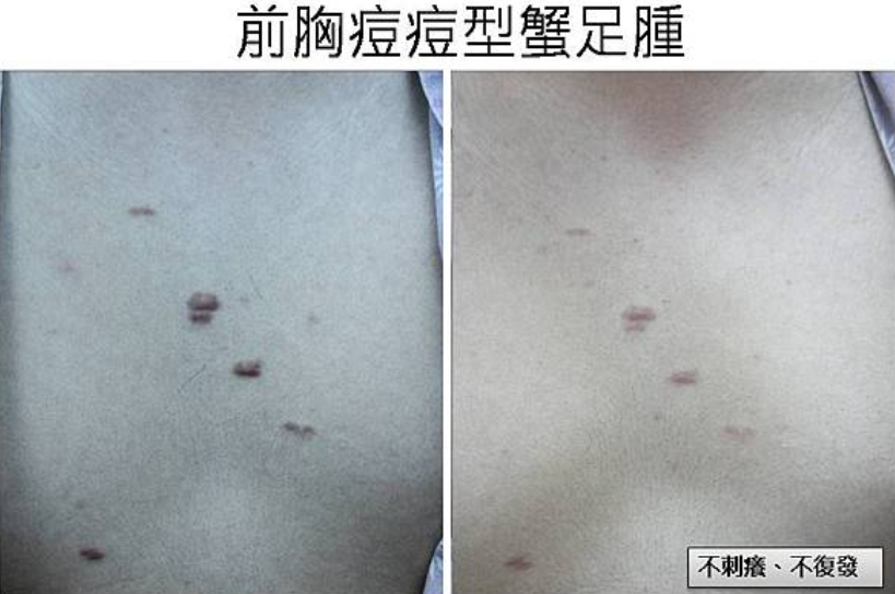 蟹足腫