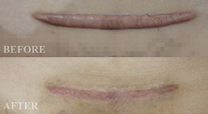 蟹足腫