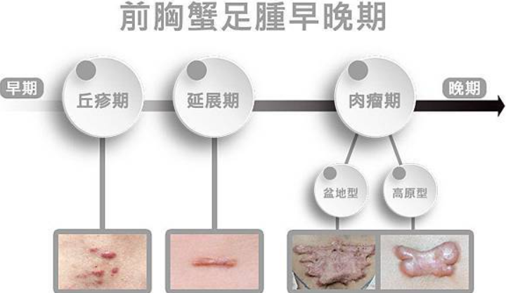 蟹足腫