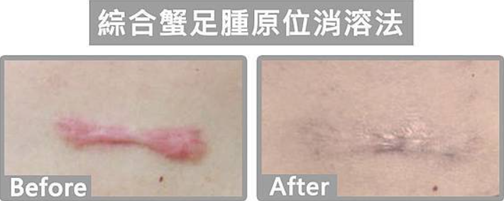 蟹足腫