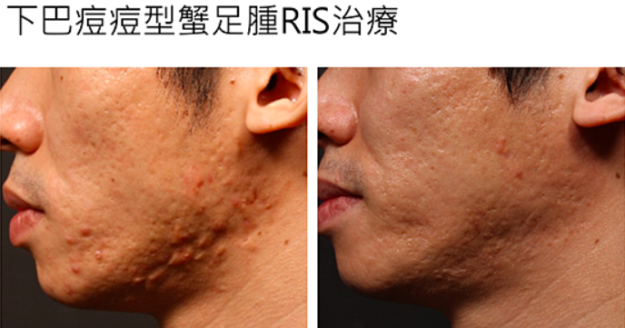 蟹足腫