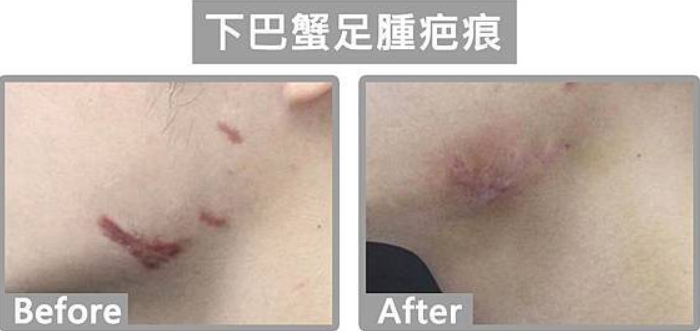 蟹足腫