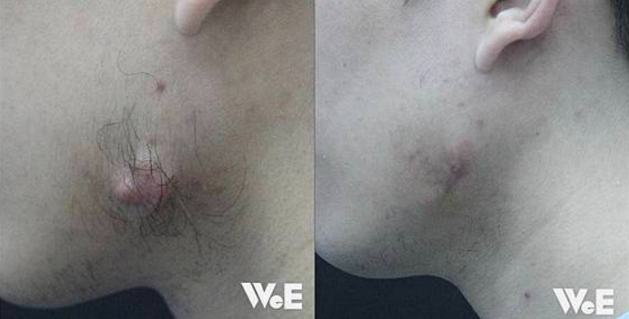 蟹足腫