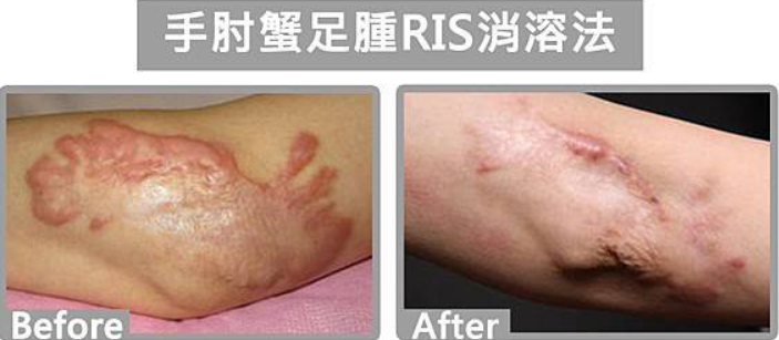 蟹足腫