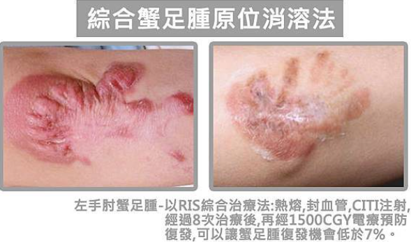 蟹足腫