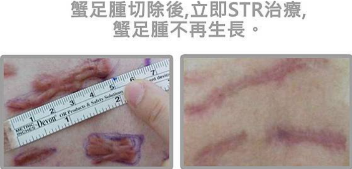 蟹足腫