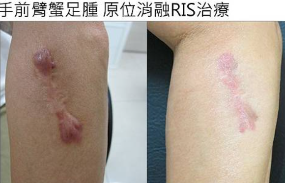 蟹足腫