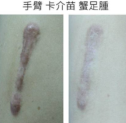 蟹足腫