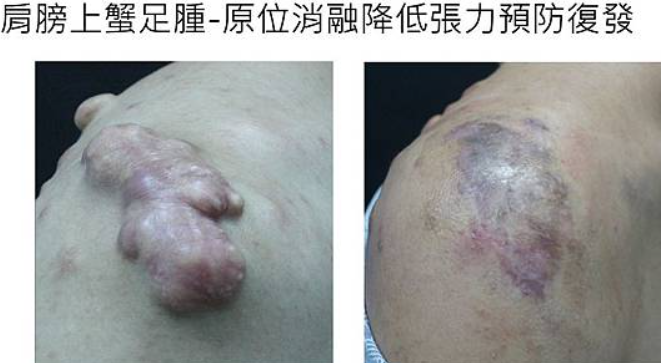 蟹足腫