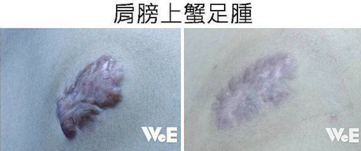 蟹足腫